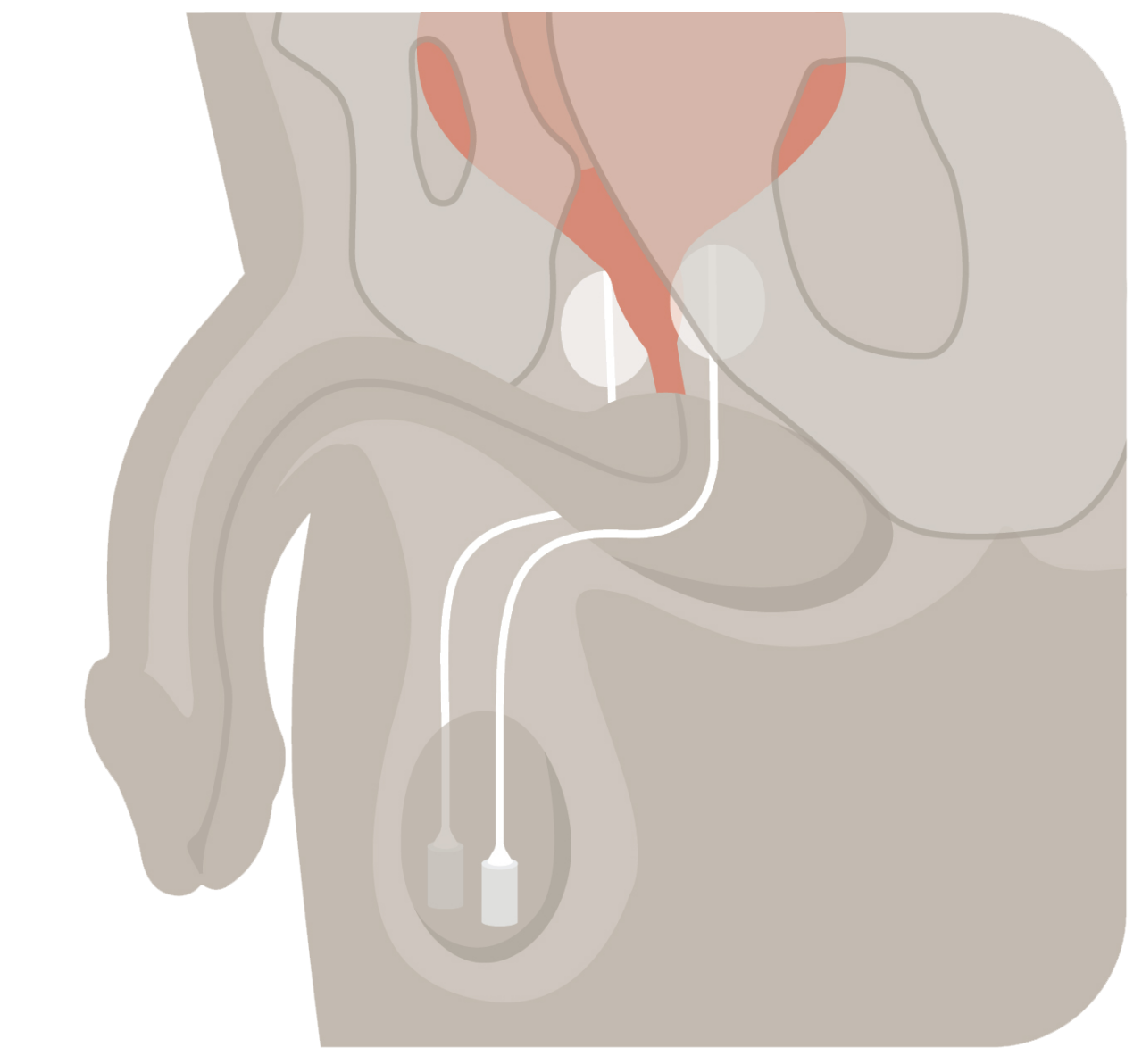 An illustration of the Coloplast ProACT system showing the device in the body with the balloons of the device positioned at the top of the neck of the bladder.